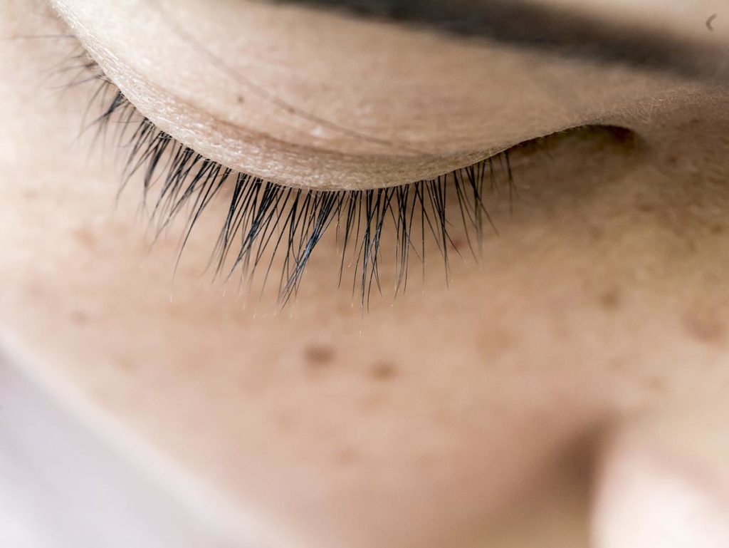 Melasma